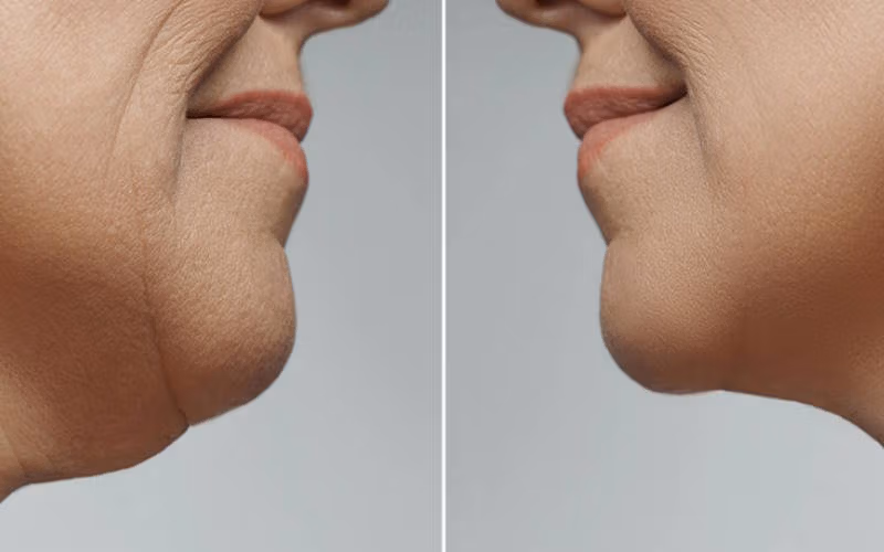 غبغب چیست و چگونه می‌توان آن را از بین برد؟