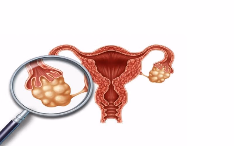 سندرم تخمدان پلی کیستیک (PCOS) چیست؟ علائم، علت، درمان و راههای کنترل